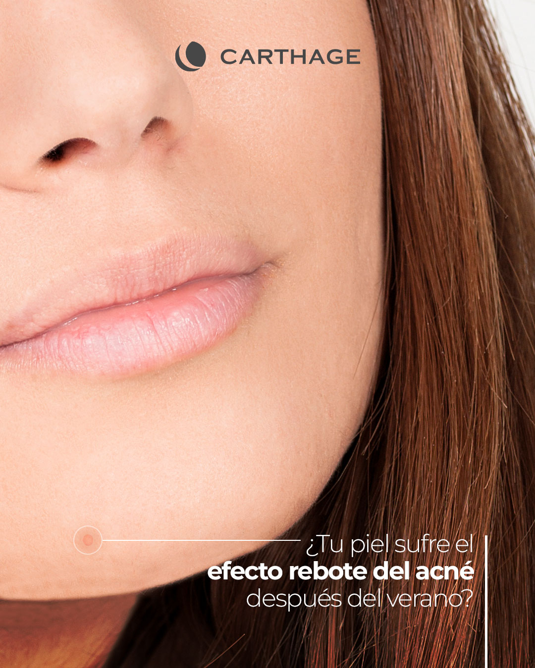 ¿Tu piel sufre el efecto rebote del acné después del verano?